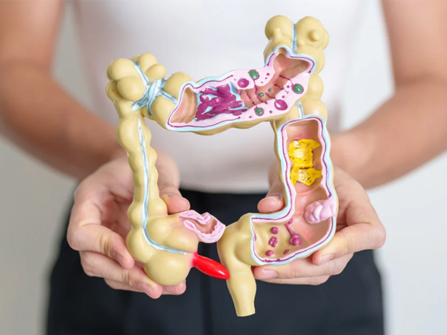 IBD Hastaları için Bağırsak Kanseri Tahmin Testi