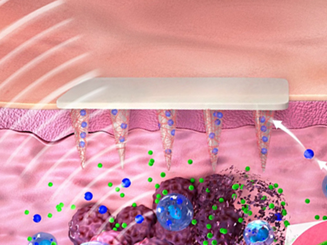 Kanser Biyobelirteçlerini Ölçen Mikroiğneli Cilt Yaması 