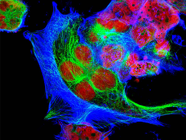 Nöroblastoma Araştırması Daha Kesin Prognozların Kilidini Açabilir