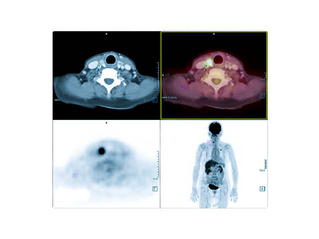 Tiroid Kanserini Teşhis Etmek için Yapay Zeka ve Multispektral Fotoakustik Görüntüleme