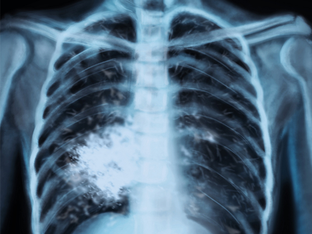 Bilim İnsanları Astımın Yol Açtığı Akciğer Hasarının Yeni Nedenini Buluyor
