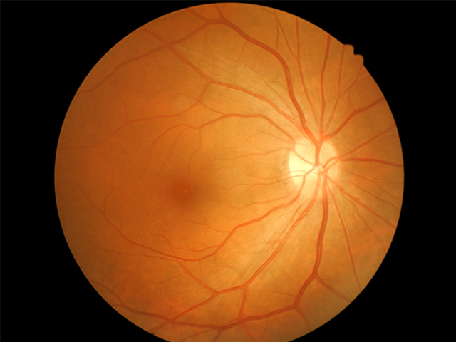 COVID-19 Kan-Retina Bariyerini Aşıp Görmeye Zarar Verebilir