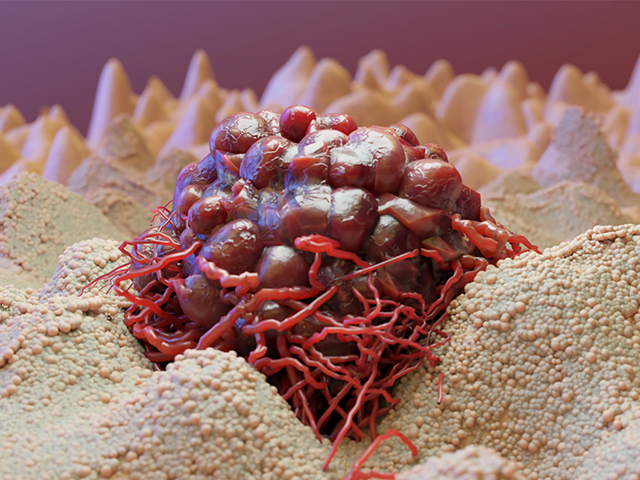 Anneksin-A1'in Hedeflenmesi Kanser Hücresi Büyümesini Durdurabilir