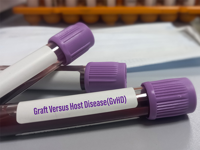 NHS Yeni Graft Versus Host Hastalığı Tedavisini Kullanıma Sunuyor