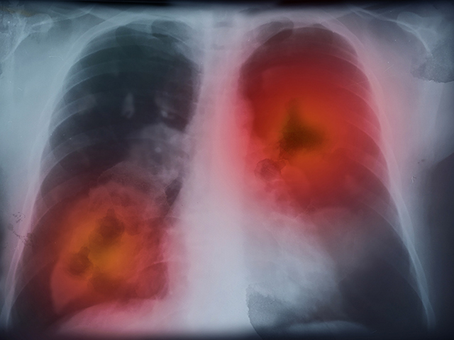 NHS Binlerce Hastada Pilot Akciğer Kanseri Kan Testi Denedi