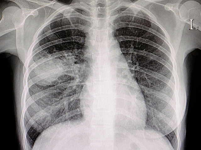 Erken Yaşam Faktörleri Akciğer Sağlığını Yetişkinlikte Nasıl Etkileyebilir?