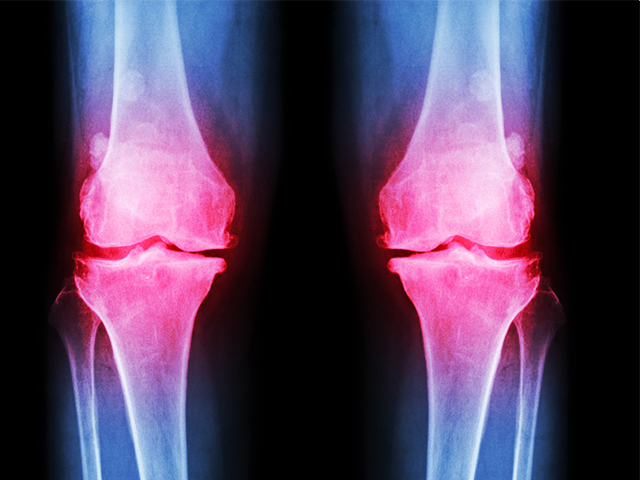Osteoartriti Tedavi Etmek için Yeni Umut