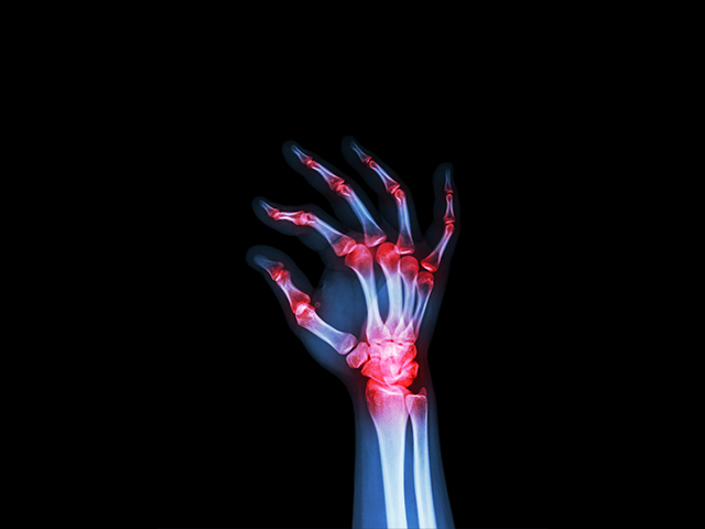 Romatoid Artrit Tedavisinde Devrim Yaratabilecek Yeni İlaç